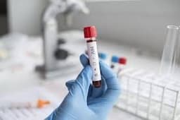 HIV Treatment